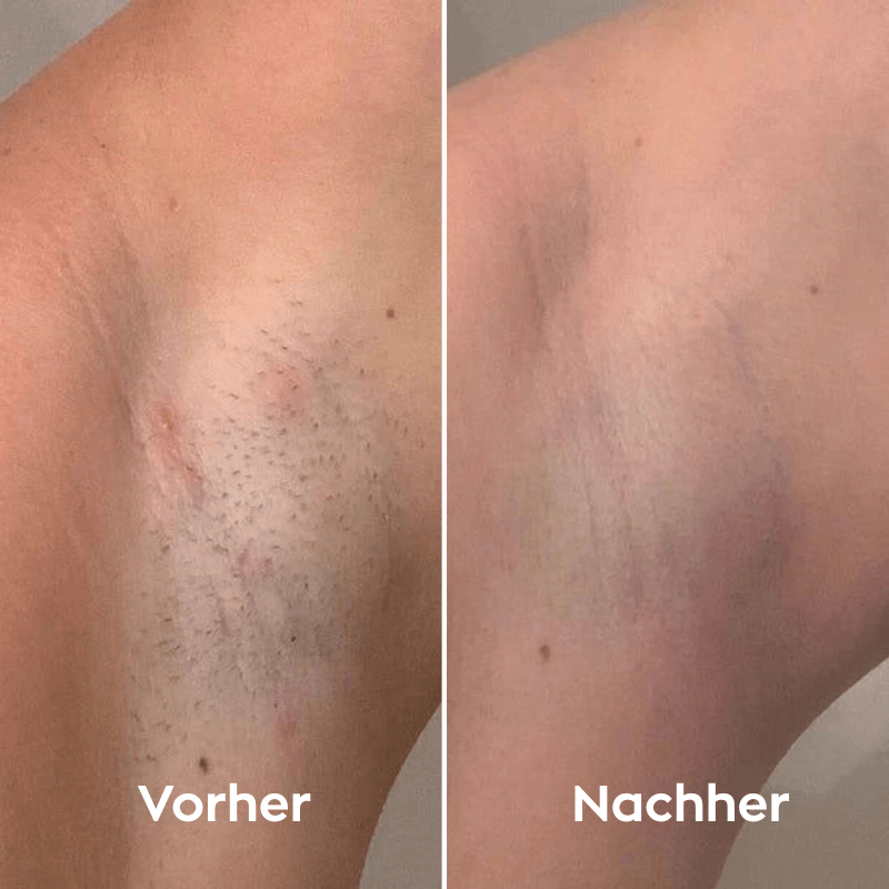 Depilo IPL Max - Dauerhafte Haarentfernung