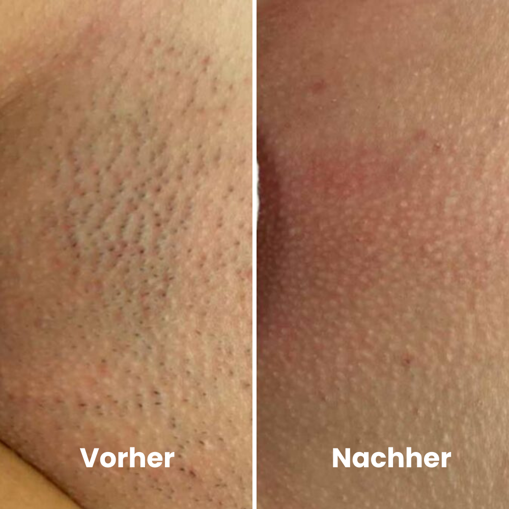 DEPILO – Dauerhaft Haarfrei Bundle