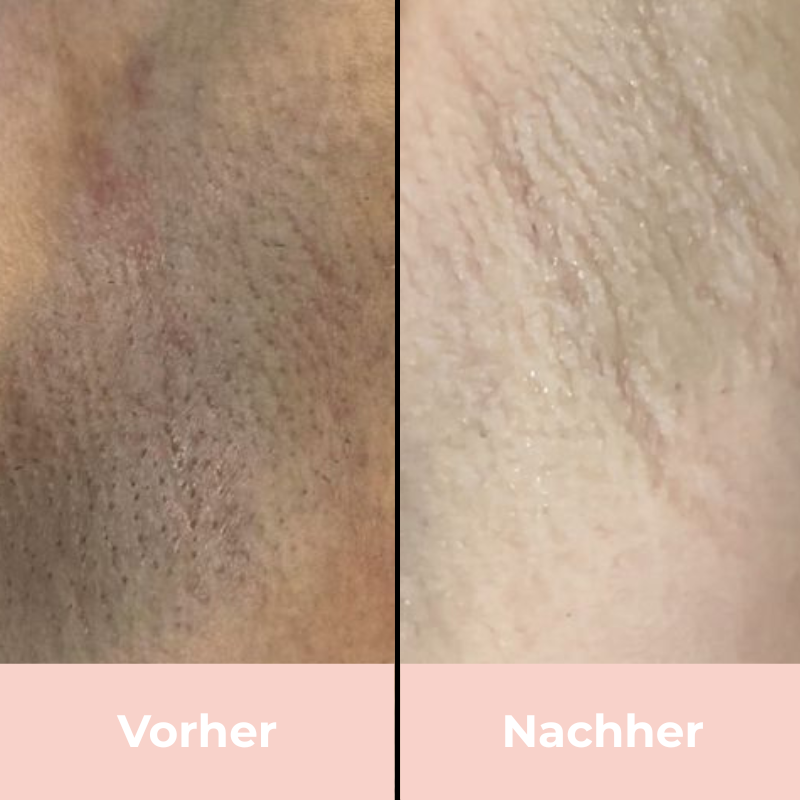 Depilo IPL Max - Dauerhafte Haarentfernung