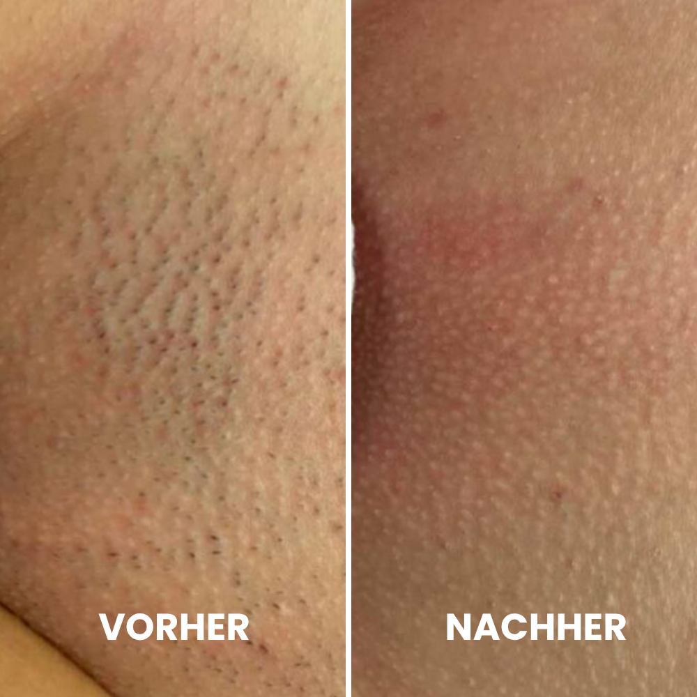 Depilo IPL Max - Dauerhafte Haarentfernung