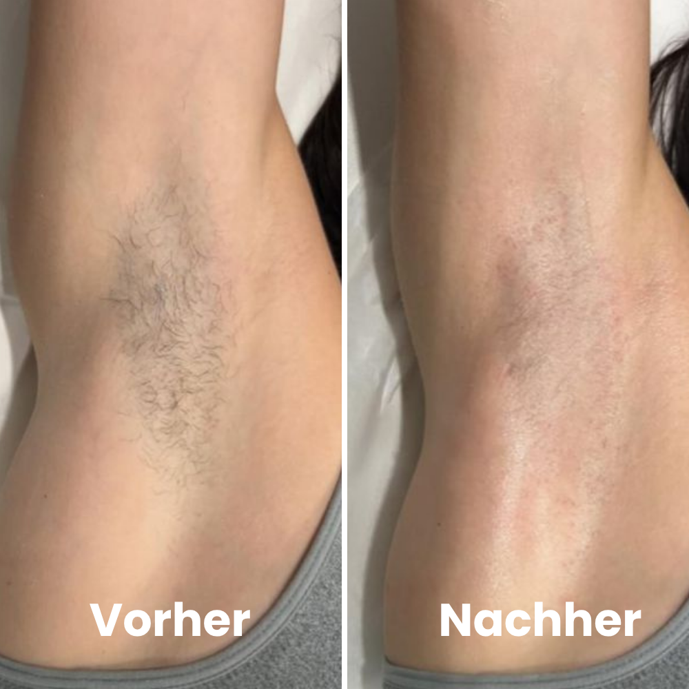 Depilo IPL Max - Dauerhafte Haarentfernung