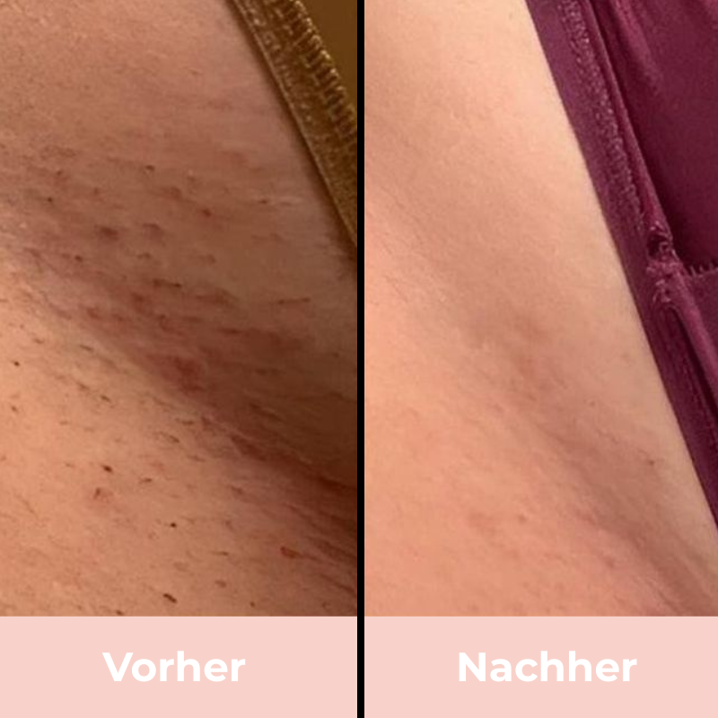 Depilo IPL Max - Dauerhafte Haarentfernung