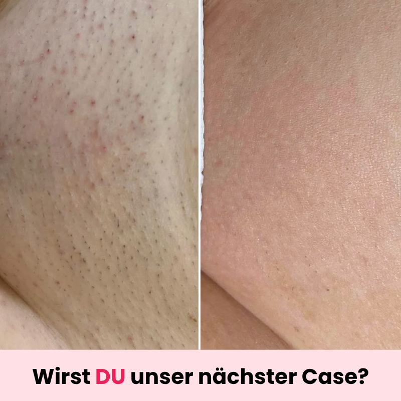 DEPILO – Dauerhaft Haarfrei Bundle