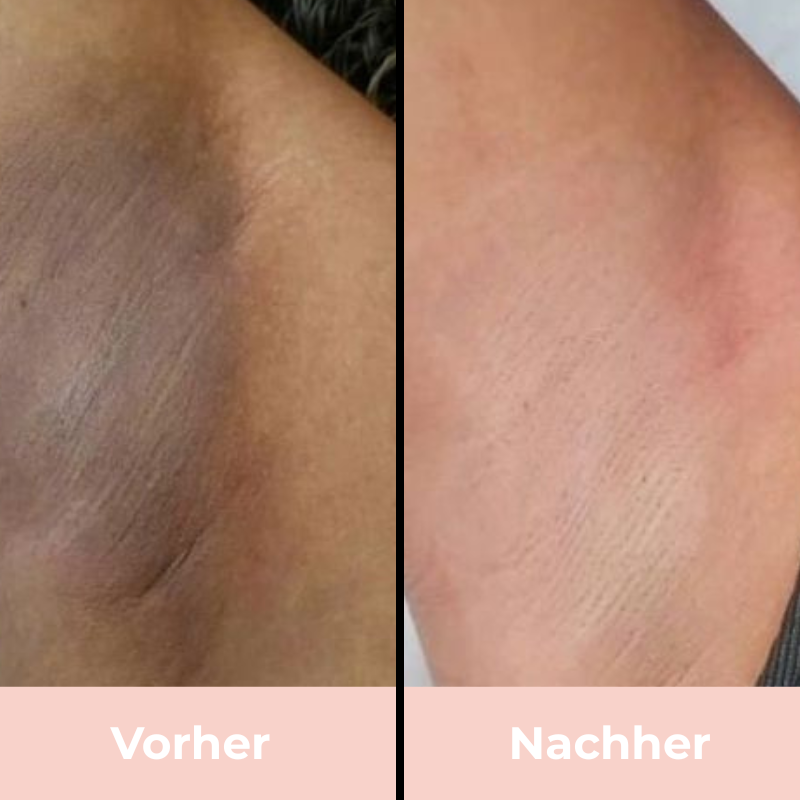 Depilo IPL Max - Dauerhafte Haarentfernung