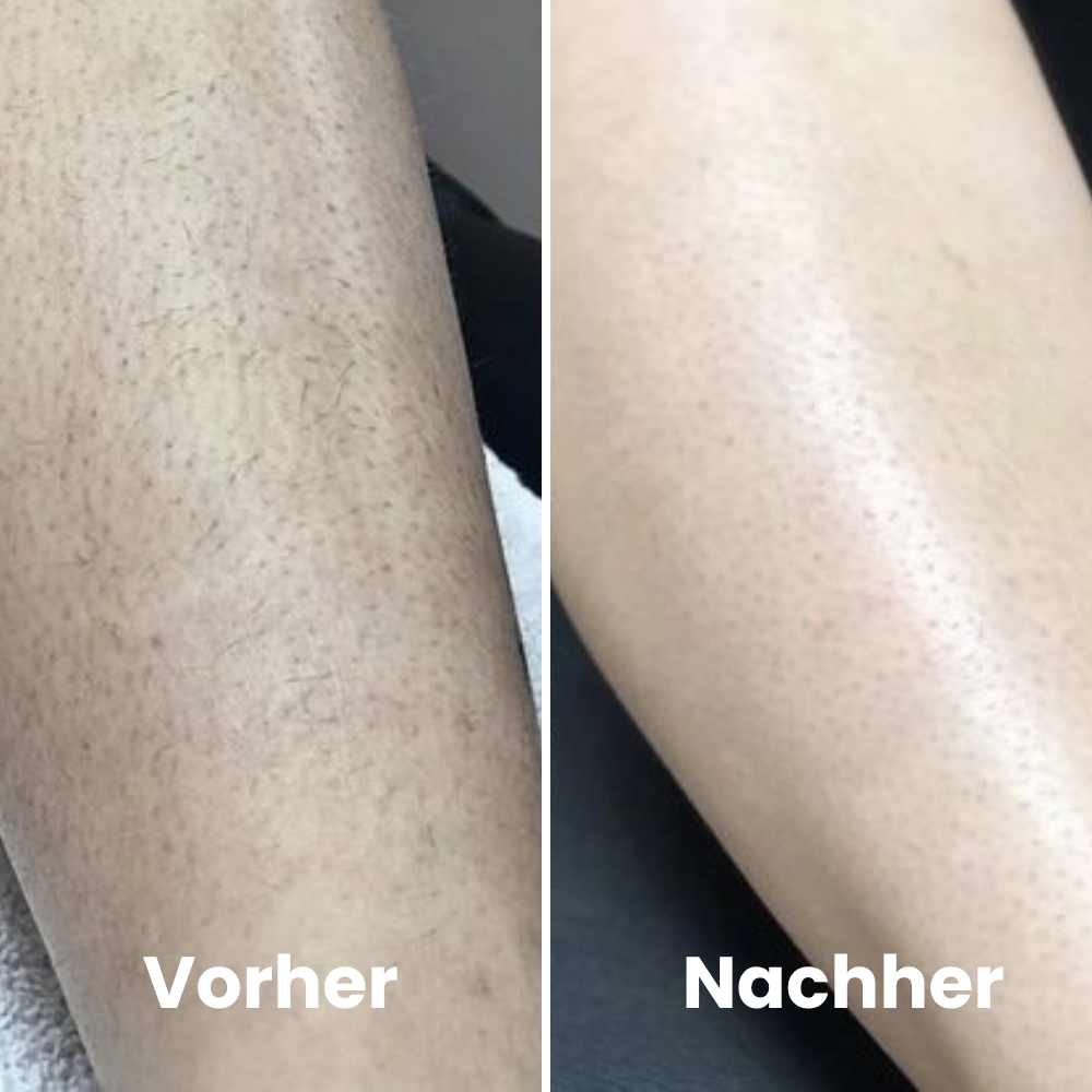 Depilo IPL Max - Dauerhafte Haarentfernung