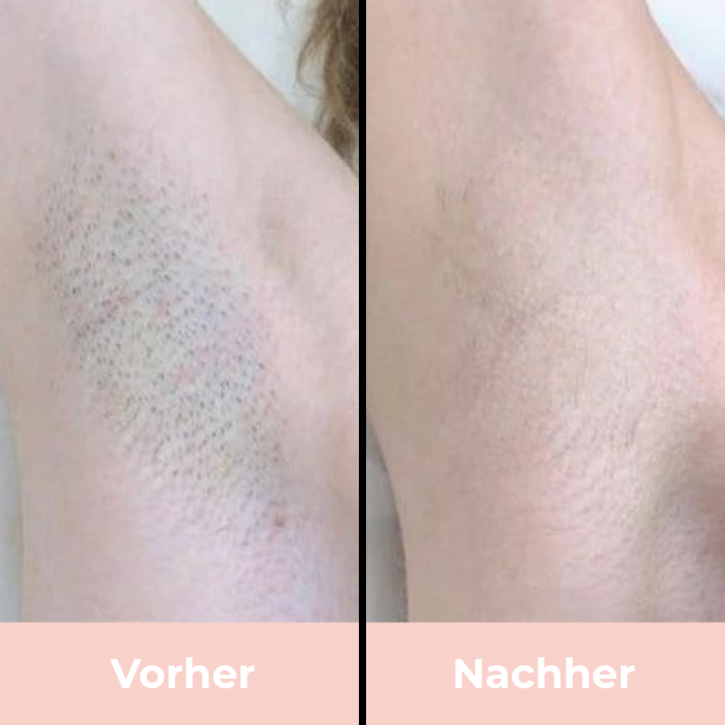 Depilo IPL Max - Dauerhafte Haarentfernung