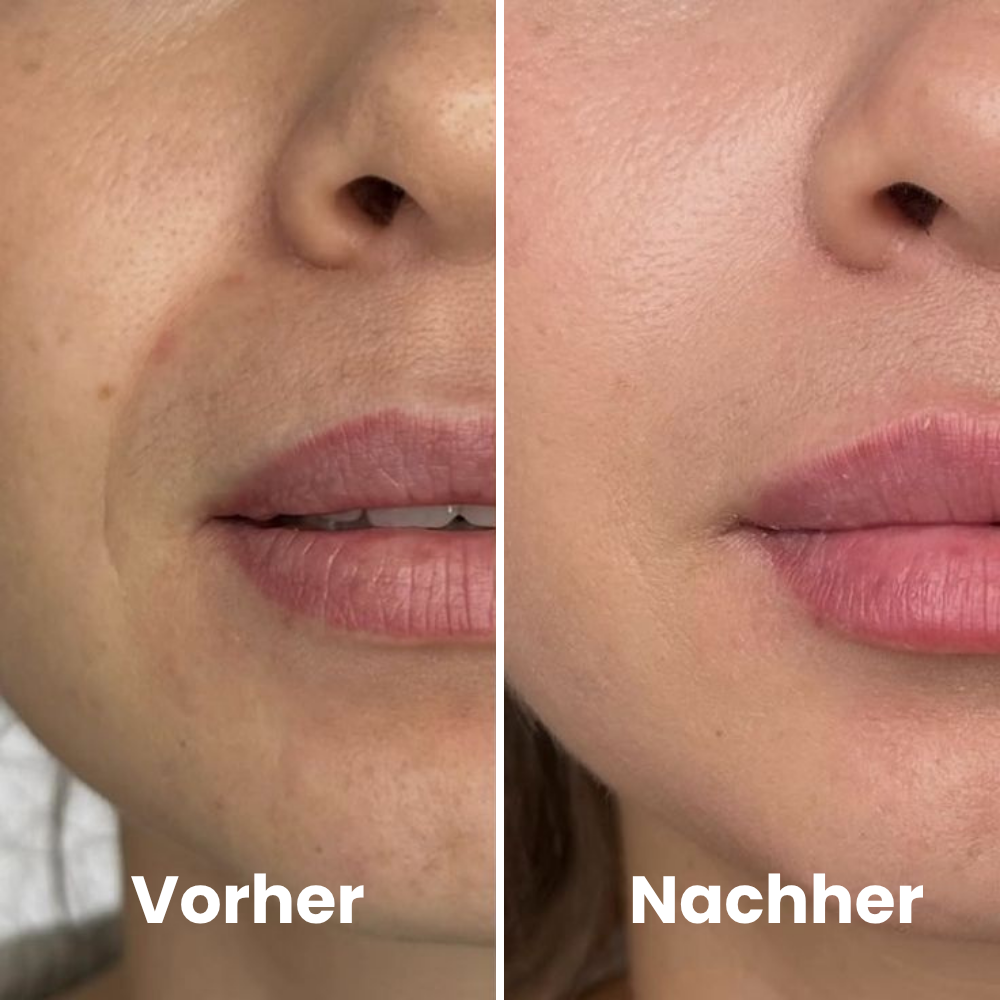 Depilo IPL Max - Dauerhafte Haarentfernung