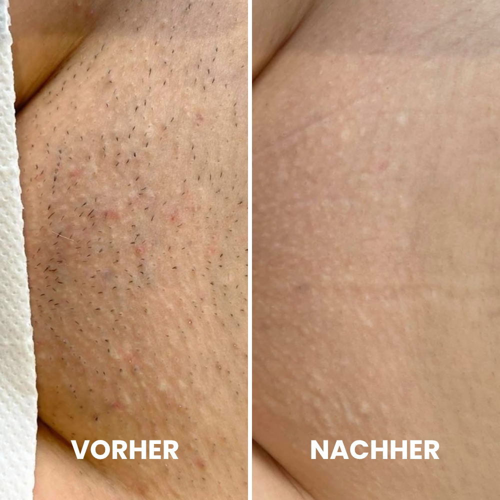 Depilo IPL Max - Dauerhafte Haarentfernung