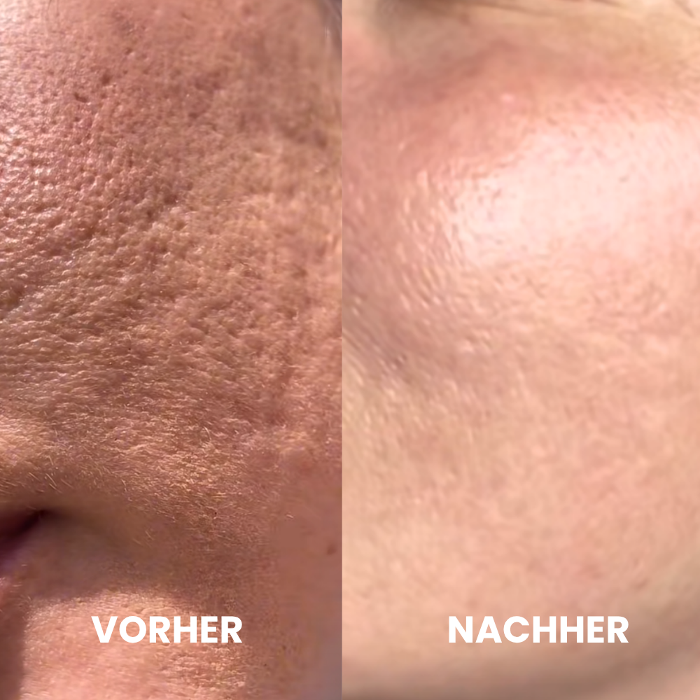 Depilo IPL Max - Dauerhafte Haarentfernung