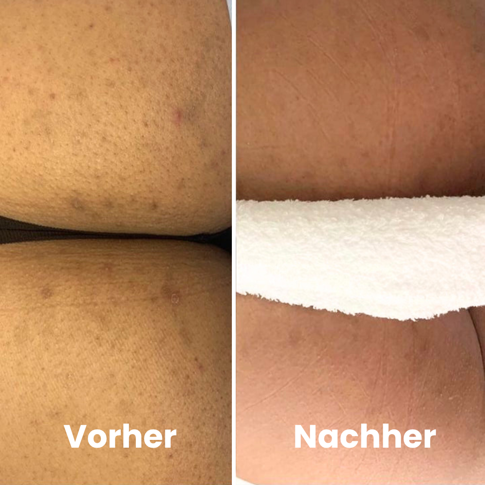 Depilo IPL Max - Dauerhafte Haarentfernung