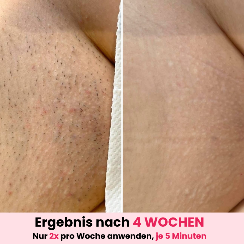 DEPILO – Dauerhaft Haarfrei Bundle