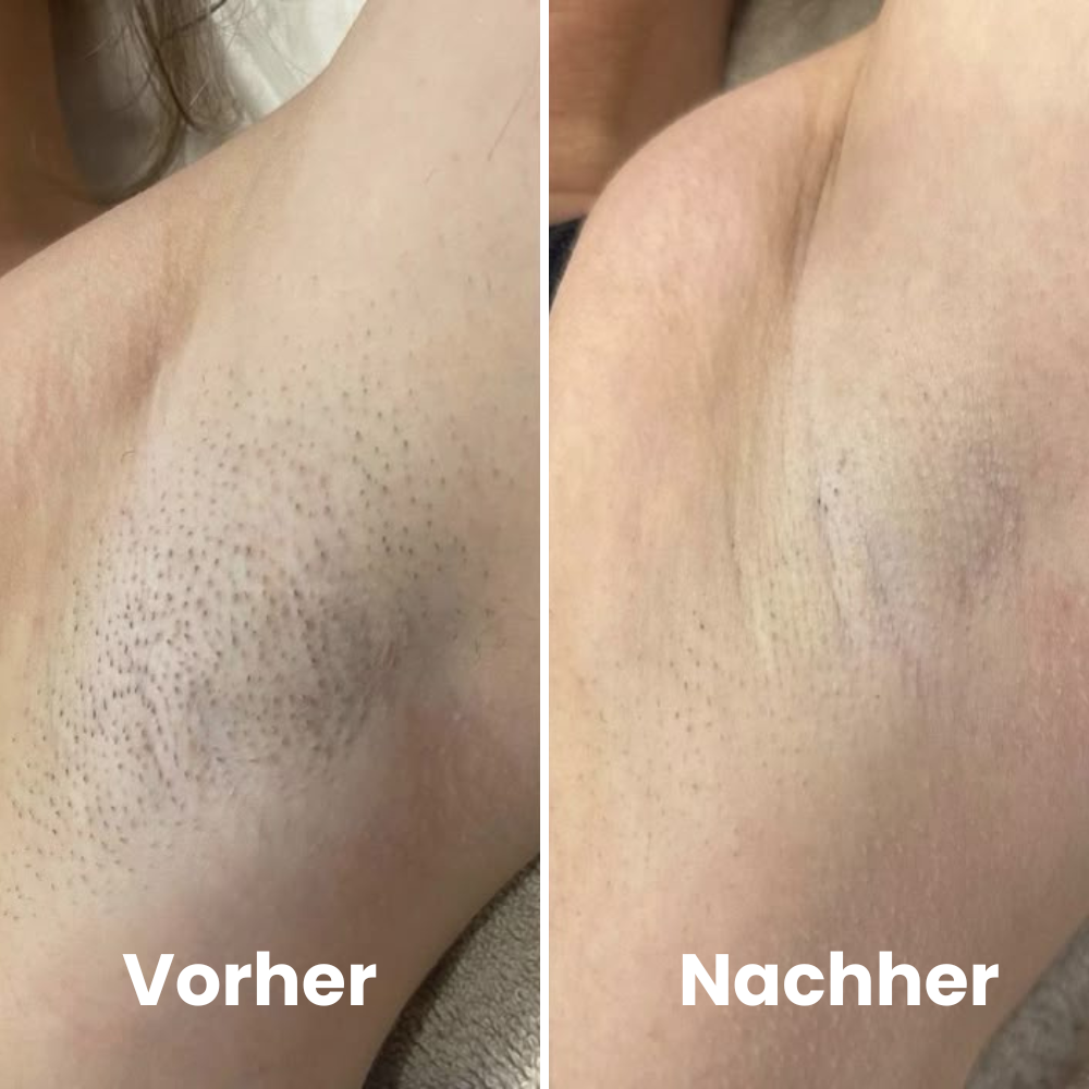 Depilo IPL Max - Dauerhafte Haarentfernung