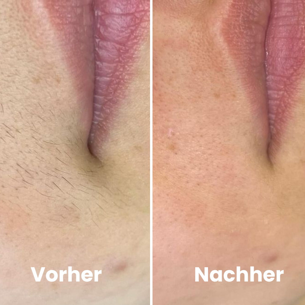 Depilo IPL Max - Dauerhafte Haarentfernung