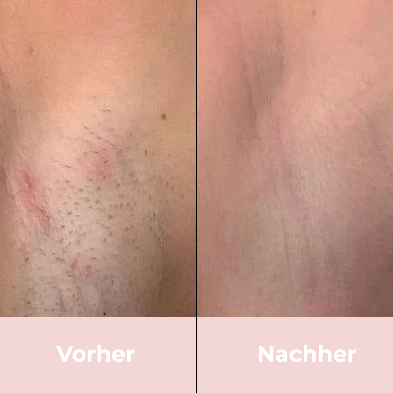 Depilo IPL Max - Dauerhafte Haarentfernung