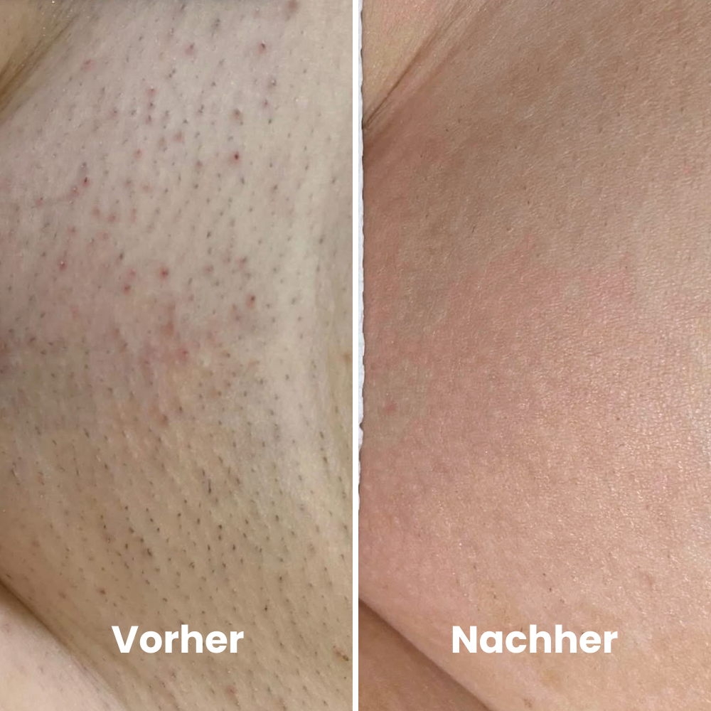 DEPILO – Dauerhaft Haarfrei Bundle