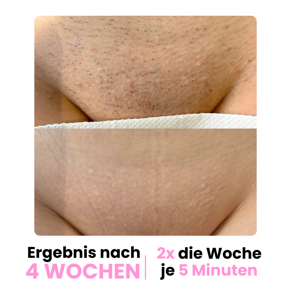 DEPILO – Dauerhaft Haarfrei Bundle